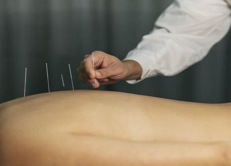 Acupuncture